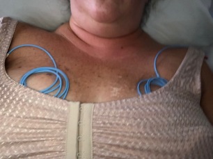 Right out of surgery- those lines on my chest are the Doppler’s they will hook up to make sure I have good blood flow.
